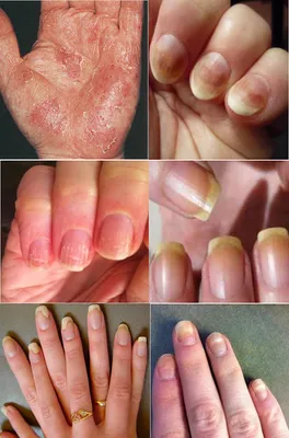 Грибковые заболевания кожи