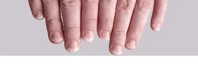 Причины, симптомы и лечение грибковой инфекции: чем лечить микоз ногтей и  кожи