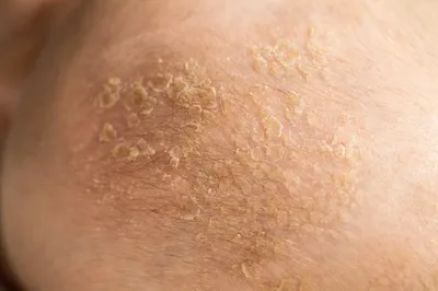 Грибковые заболевания кожи реферат по медицине | Сочинения Медицина |  Docsity