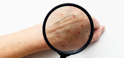 Грибок на человеческой коже Макрос Стоковое Фото - изображение  насчитывающей гигиена, заболевание: 100860616