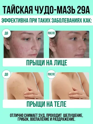 Грибковые заболевания кожи у детей - признаки, причины, симптомы, лечение и  профилактика - iDoctor.kz