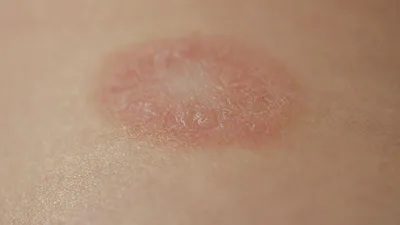 Как вылечить грибок кожи: симптомы болезни и возможное лечение грибка кожи