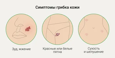 Грибок ногтей на ногах: стадии, лечение, профилактика в домашних условиях