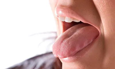 Белый налет на языке у взрослого или ребенка - причины появления, лечение  заболеваний, обратиться к врачу, если обложен язык