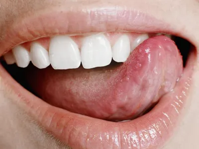 Чистка языка от налета в домашних условиях - Как правильно чистить язык при  чистке зубов
