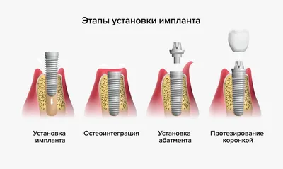 Имплантация зубов - ГАУЗ Республиканская стоматологическая поликлиника