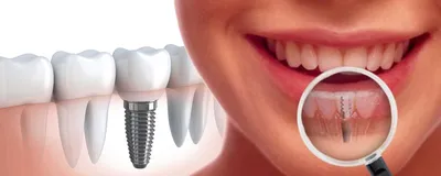 Имплантация зубов: этапы и сроки | Блог | Стоматология «Дент Тайм»