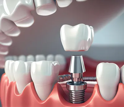 Имплантация зубов - стоит ли делать? - Cтоматология Май