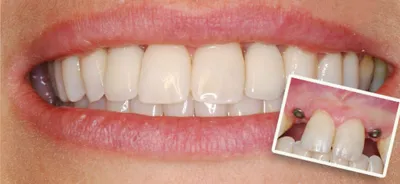 Кейсы стоматологических имплантаций: фото до и после в клиниках Чистое  Дыхание СПб