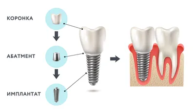 Имплантация зубов Днепр: цена имплантации 1 зуба под ключ