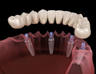 Одномоментная имплантация зубов в Калуге цены