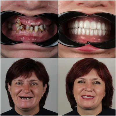 Имплантация зубов и их виды | Стоматология Багита