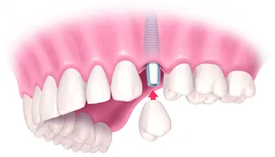 Имплантация зубов в Санкт-Петербурге: цены на установку имплантата, запись  на прием в SDS Clinic