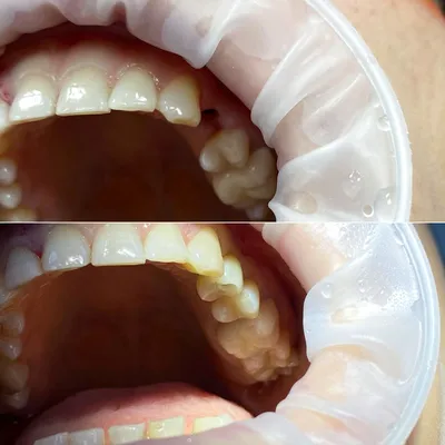 Имплантация зубов в Перми - Стоматология Visual Dental