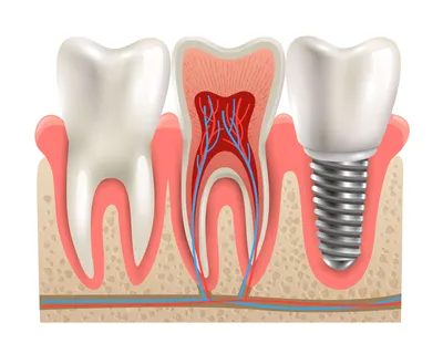 Имплантация зубов - недостатки и достоинства - Cтоматология Май