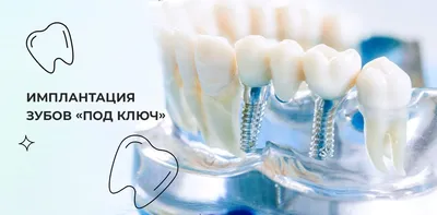 Имплантация зубов в Москве под ключ, виды и цены на импланты – МариЛав