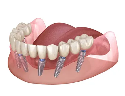 Имплантация зубов «под ключ» в Краснодаре: отзывы и цены | ЦРС