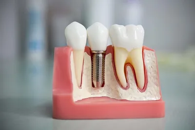 Полная имплантация зубов - Имплантация при полном отсутствии зубов, цены |  НоваДент