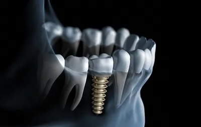 Имплантация зубов: преимущества, недостатки, риски - Статьи