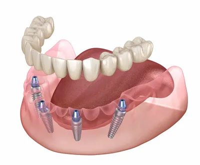 Мини-импланты зубов: преимущества, процедуры, цена | РИЦА