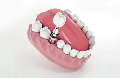 Имплантация зубов - методы и отзывы пациентов о зубных имплантах. Часть 1
