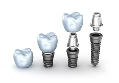 Имплантация зубов в Курске: цены на имплантацию зубов в стоматологии Doctor  Smile