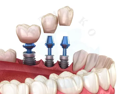 Имплантация зубов