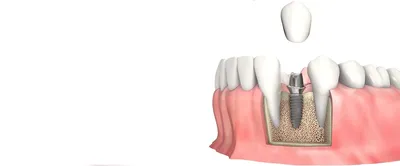 Имплантация зубов в Краснодаре: установка, типы, преимущества, отзывы, цены  - Стоматология доктора Айрумова «32 Clinic»