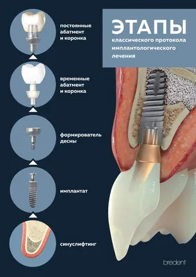Имплантация зубов в Омске цены — Стоматология Элита