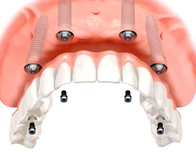 ᐉ Имплантация зубов «Под ключ» 【Цена ~ 18699 грн.】 в Декабре 2023 |  Стоматология «Бланко» Днепр
