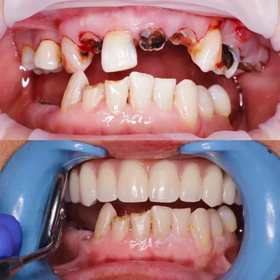 Имплантация зубов - Силк Смайл