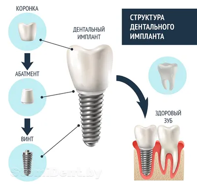 Имплантация зубов в Хабаровске: цена за 51 200 ₽ под ключ – EsteticaDent.ru