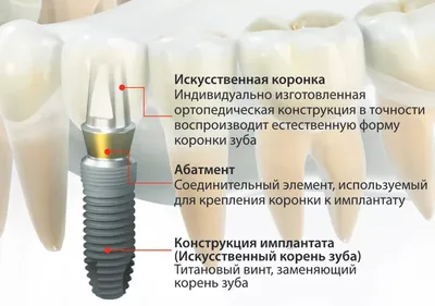 Одномоментная имплантация зубов в Екатеринбурге «под ключ»