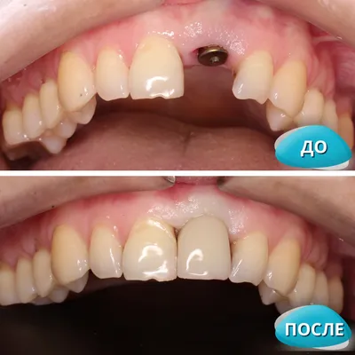 Имплантация зубов – VivaDens
