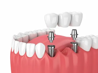 Базальная имплантация зубов - что значит, плюсы и минусы, как делают