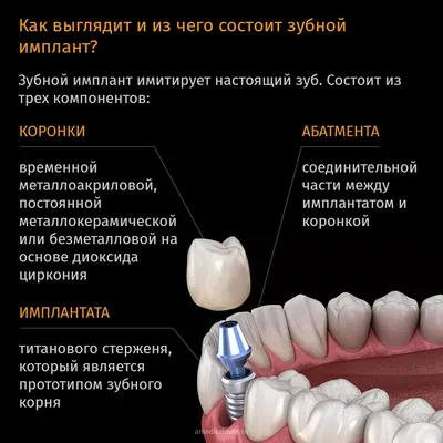 Имплантация зубов верхней челюсти в Москве под ключ недорого, цены от  ДантистоФФ