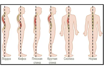 Медицинский центр Доктор Ост - Позвоночник-это наша опора и поддержка в  прямом смысле, поэтому особенно важно заботиться о его здоровье. 💪🏻  Искривление позвоночного столба – это ▫️ нарушенная осанка; ▫️ изменение  конфигурации