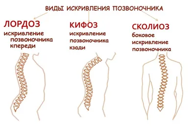 Сколиоз у детей: причины, симптомы, лечение и профилактика | Дефектология  Проф