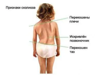 Деформации позвоночника - операции и лечение в Москве, цены на сайте ГВКГ  им. Н.Н. Бурденко