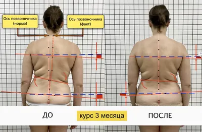 Сколиоз: Диагностика и лечение искривления позвоночника. Медика