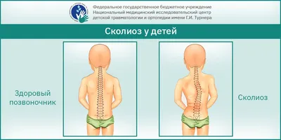 Сколиоз у детей – Реабилитационный Центр