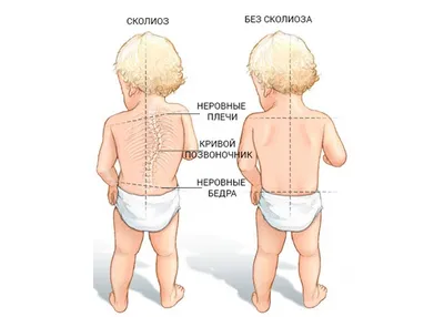 Сколиоз и искривления позвоночника | Статьи интернет-магазина ORTHOBOOM