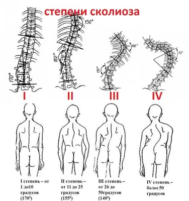 кифоз. мужчина страдает от искривления позвоночника в верхней части. шейный  позвонок вырывается и образует горб. Стоковое Фото - изображение  насчитывающей концепция, ацетона: 217368860