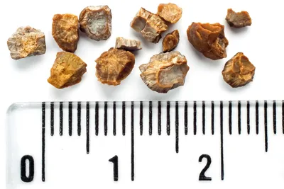 Симптомы камней в почках и способы их лечения — блог медицинского центра ОН  Клиник