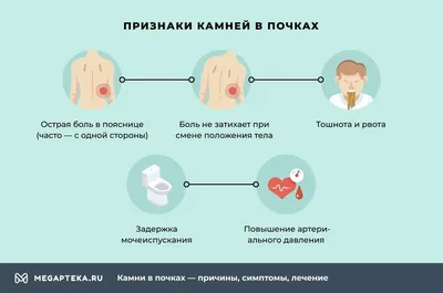 Мочекаменная болезнь (уролитиаз): лечение, виды, причины, симптомы и  диагностика заболевания