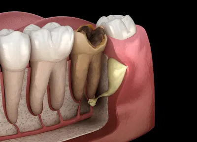 Глубокий кариес: симптомы и методы лечения зубов препаратами