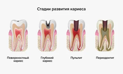 Лечение кариеса: стоимость, виды, симптомы | стоматология Нардент(МСК)