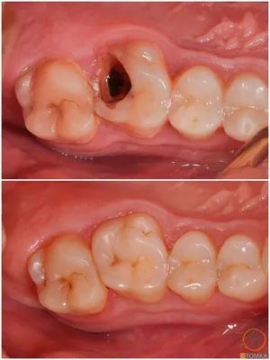 Прикорневой кариес: лечение и профилактика, причины и симптомы, цены в  Москве