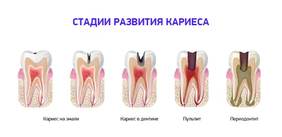 Кариес зубов: виды, симптомы и лечение | Стоматология Smile Office
