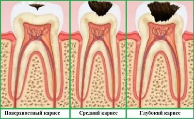 Лечение кариеса зубов в стоматологии - цены в Москве